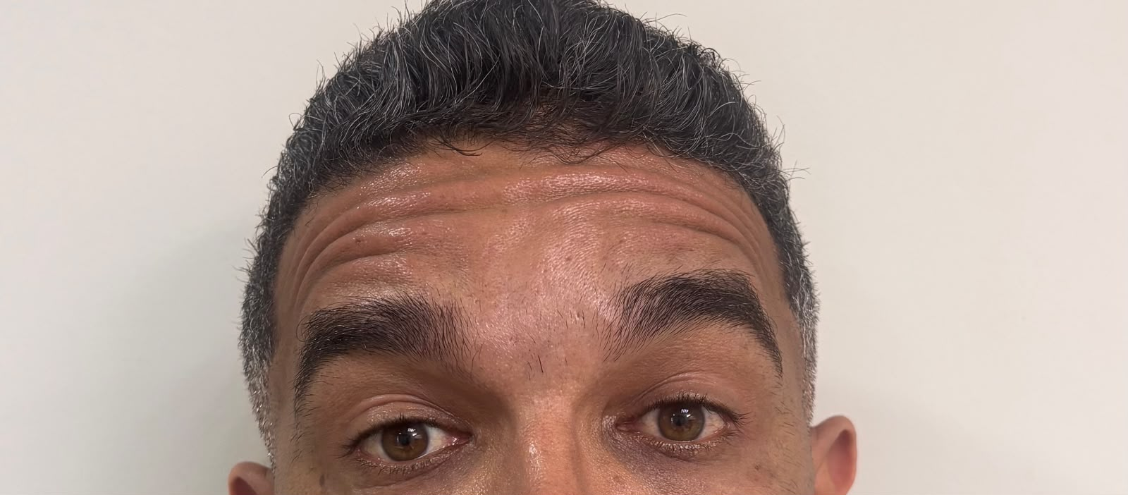 Antes do tratamento na região frontal