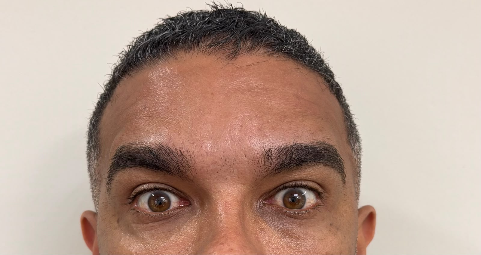 Depois do tratamento na região frontal